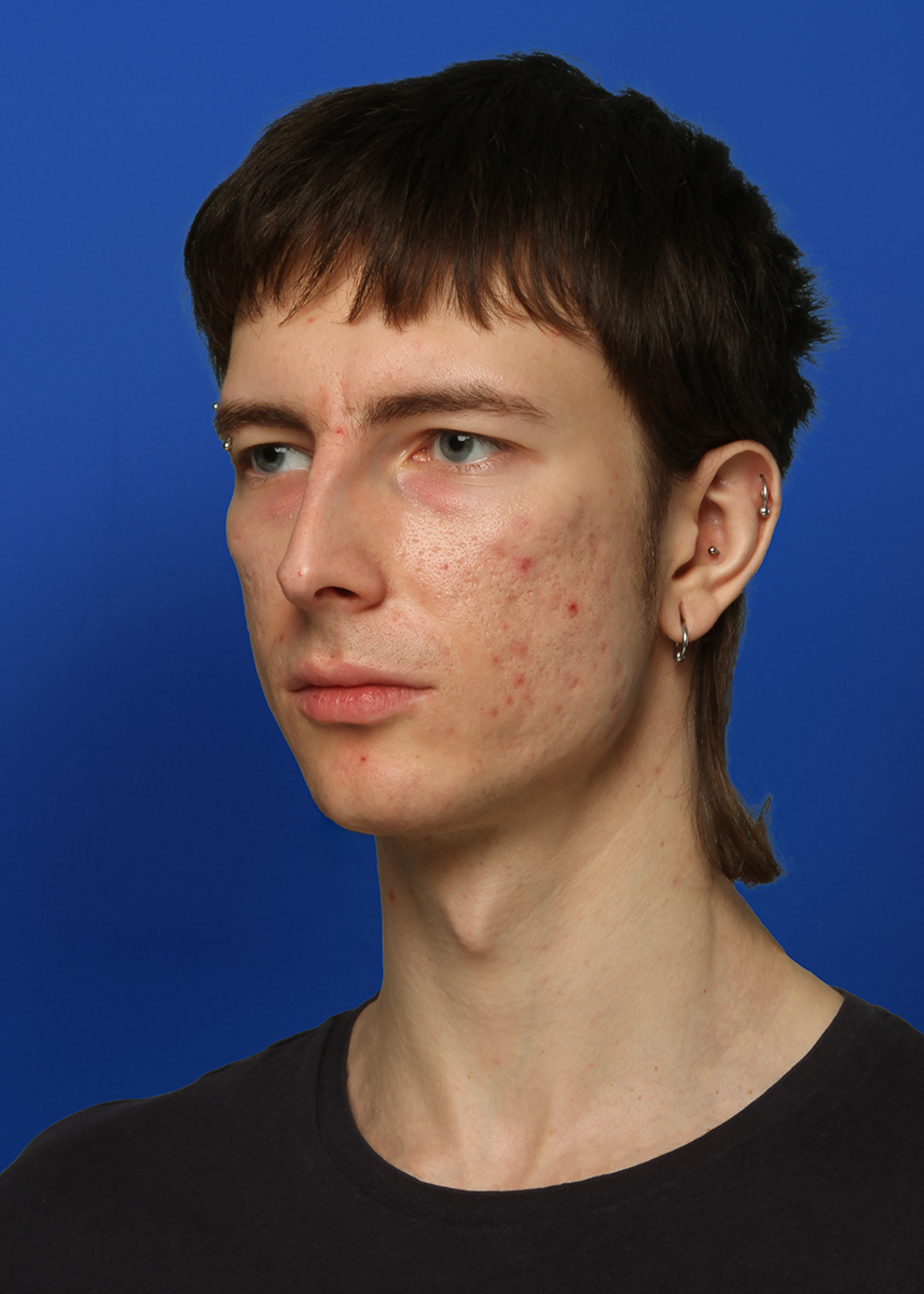 After Rhinoplasty - Front View
